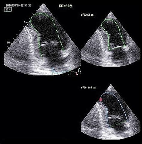 hypokinesia in echo